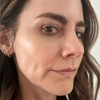 Woman's face after applying azelaic acid