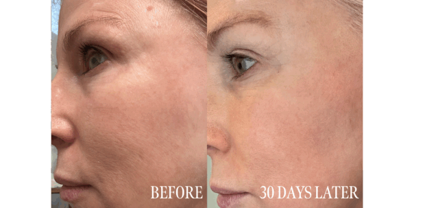 before and after laser treatment